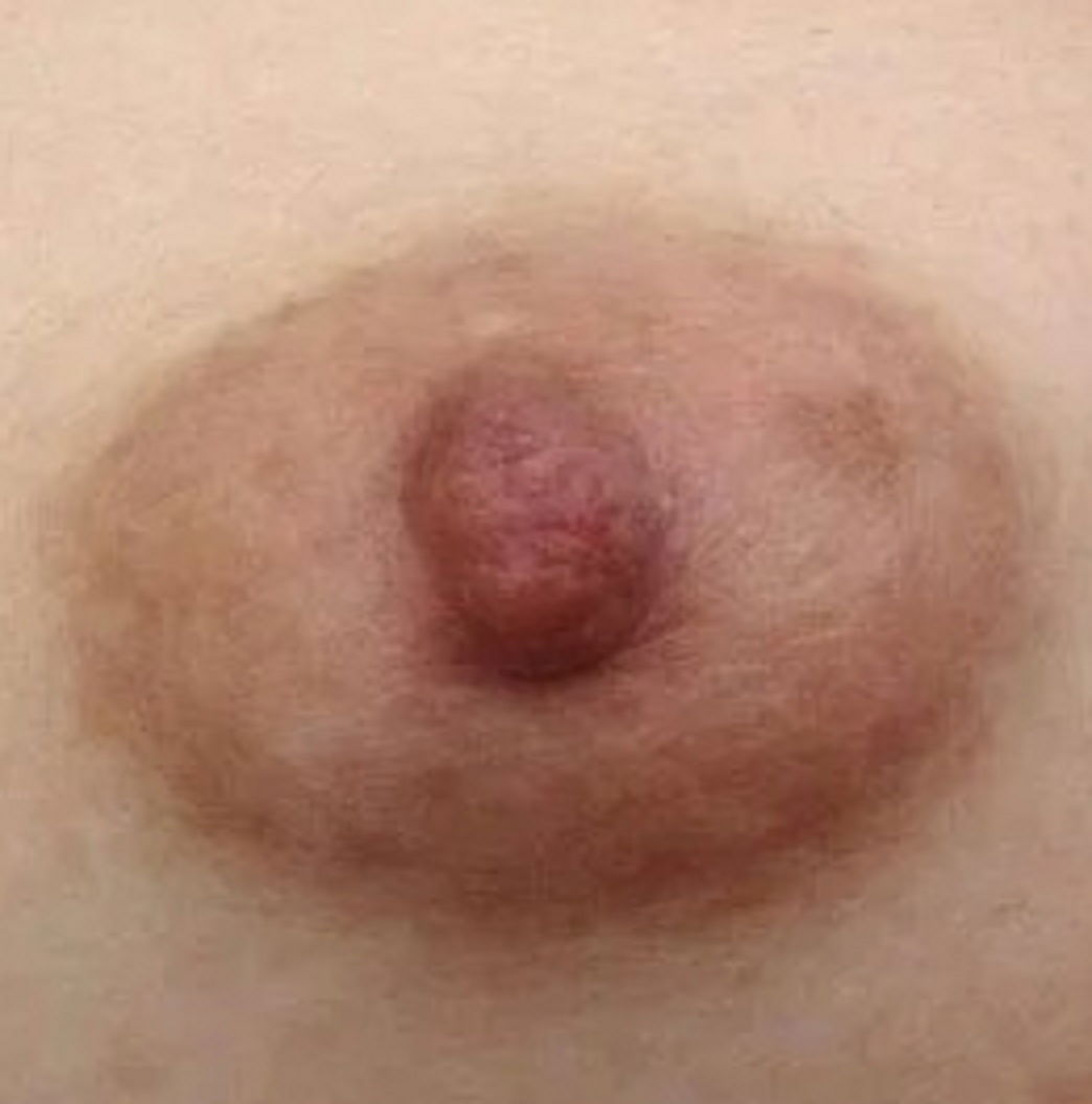 乳头和乳晕