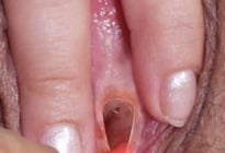 各种处女膜
